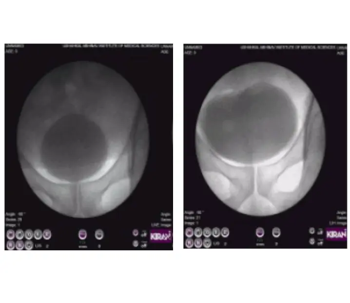 Bladder C-Arm image Urodynamics Bladder C-Arm image Urodynamics